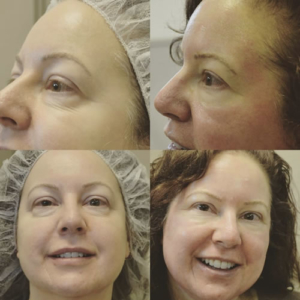 before and after photos of med spa treatments